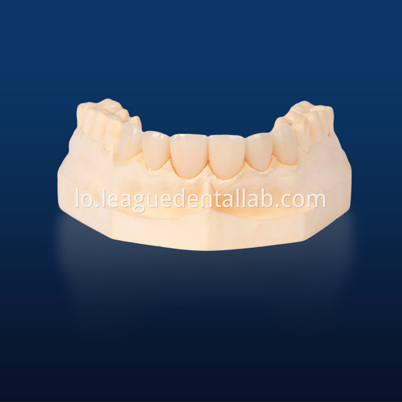 IPS Empress,Emax Onlay,Emax onlay,Emax Veneer,Lithium disilicate